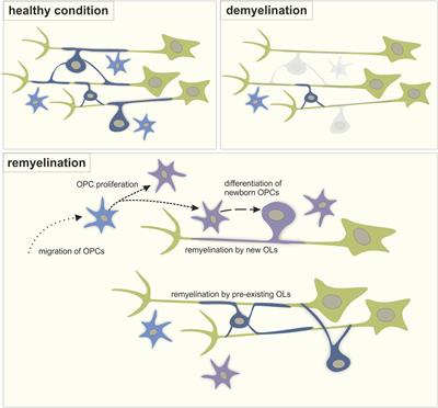 Can Enhancing Neuronal Activity Improve Myelin Repair in Multiple Sclerosis?